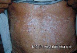 银屑病症状