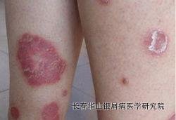 银屑病症状