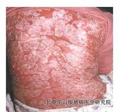 银屑病症状