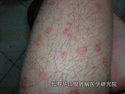 银屑病症状