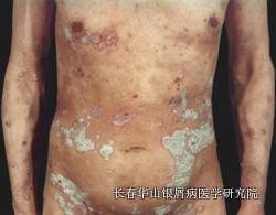银屑病症状