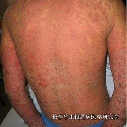 银屑病症状