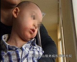 银屑病症状