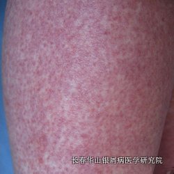银屑病症状