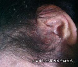 银屑病症状