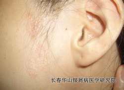 银屑病症状