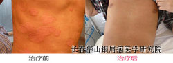 银屑病症状治疗