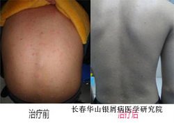 牛皮癣治疗