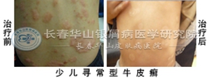 银屑病症状治疗