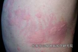 银屑病症状
