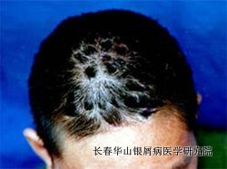 银屑病症状