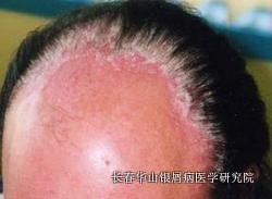 银屑病症状