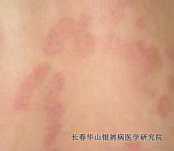 银屑病症状