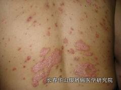 银屑病症状