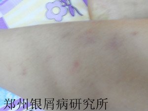牛皮癣症状