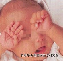 银屑病症状