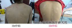儿童牛皮癣治疗