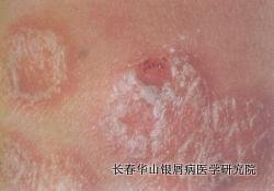 银屑病症状