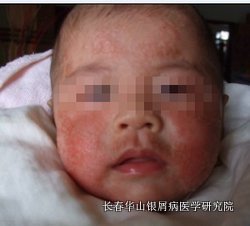 儿童银屑病