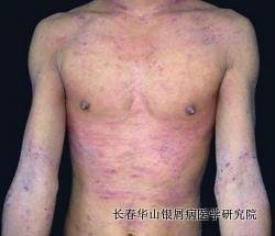 银屑病症状