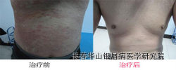 银屑病治疗