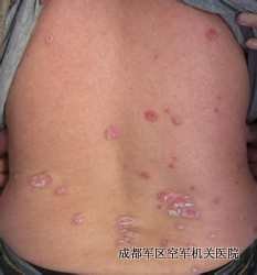 银屑病偏方