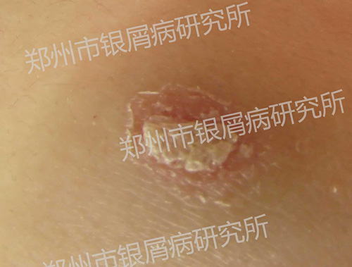 银屑病有哪些危害?