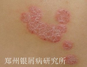 儿童牛皮癣的初期症状有哪些