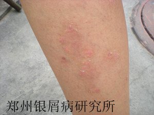 牛皮癣诊断