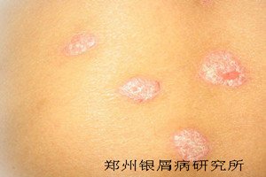 日常生活中如何辨别牛皮癣呢