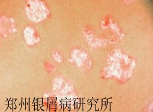 脓包型银屑病的症状有哪些呢