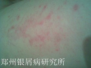 牛皮癣预防