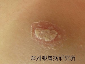 儿童牛皮癣