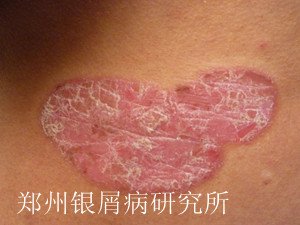 牛皮癣危害