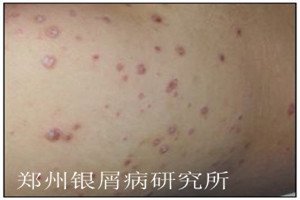 牛皮癣护理