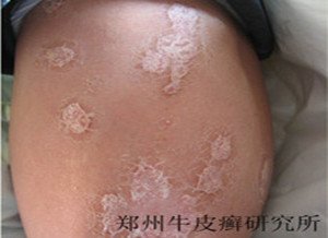 牛皮癣病因