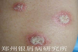 牛皮癣护理