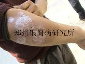 牛皮癣治疗