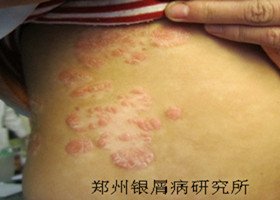 牛皮癣护理