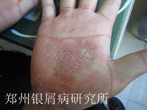 牛皮癣治疗