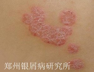 牛皮癣治疗