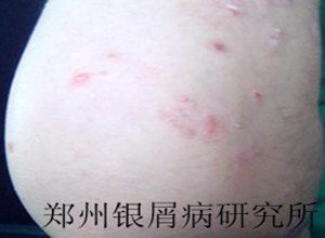 牛皮癣治疗