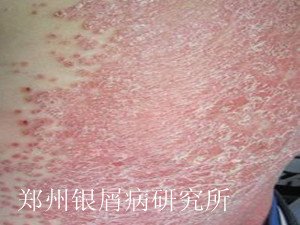 牛皮癣诊断