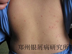 牛皮癣治疗