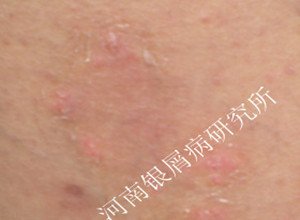 牛皮癣常识