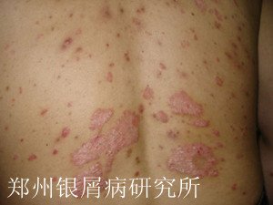 银屑病最常见的发病部位有哪些