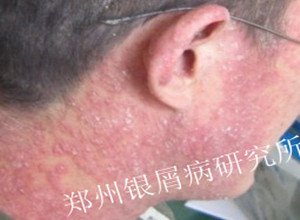 牛皮癣治疗