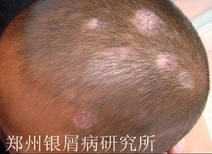 头部牛皮癣怎么治疗
