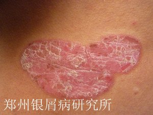 牛皮癣治疗