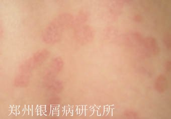 牛皮癣治疗